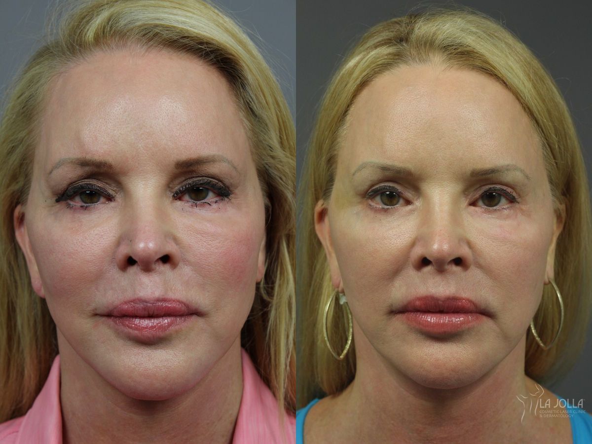 Before and after Liquid Facelift case 36418