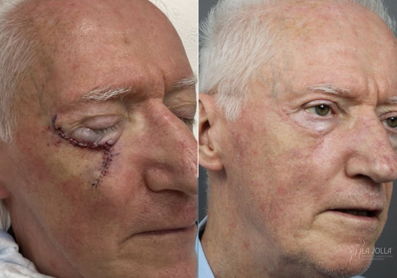 Before and after Mohs Surgery case 36093 - Angle 2