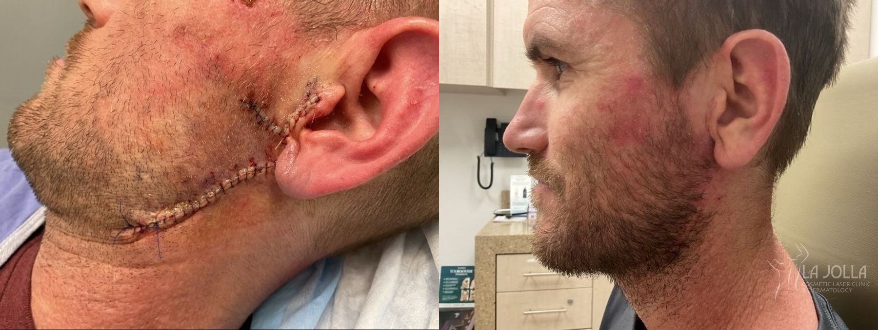 Before and after Mohs Surgery case 36430 - Angle 2