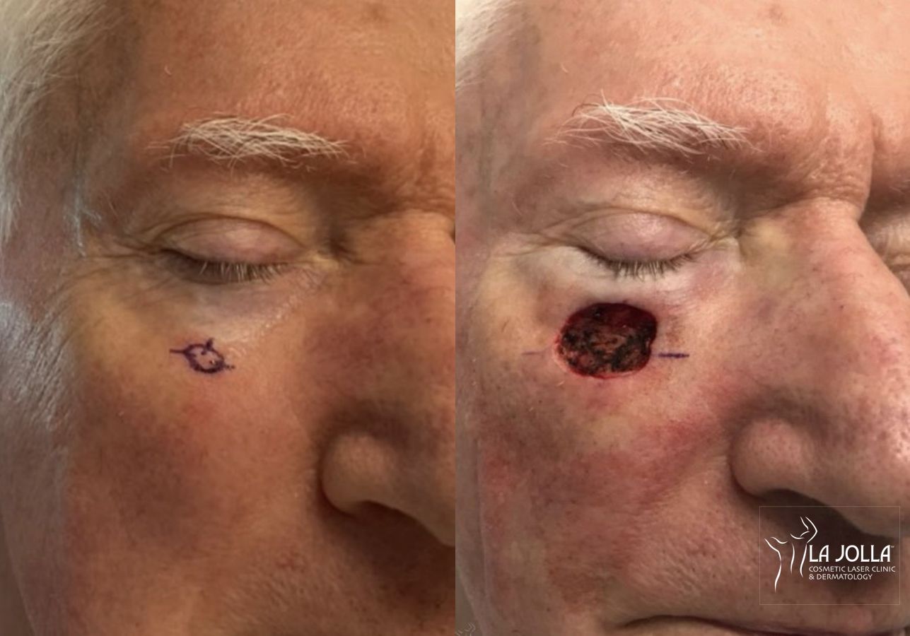Before and after Mohs Surgery case 36093