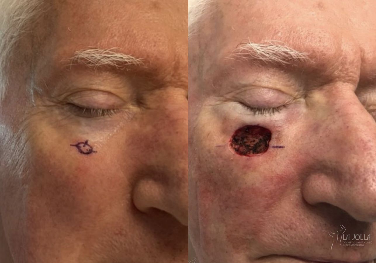 Before and after Mohs Surgery case 36093