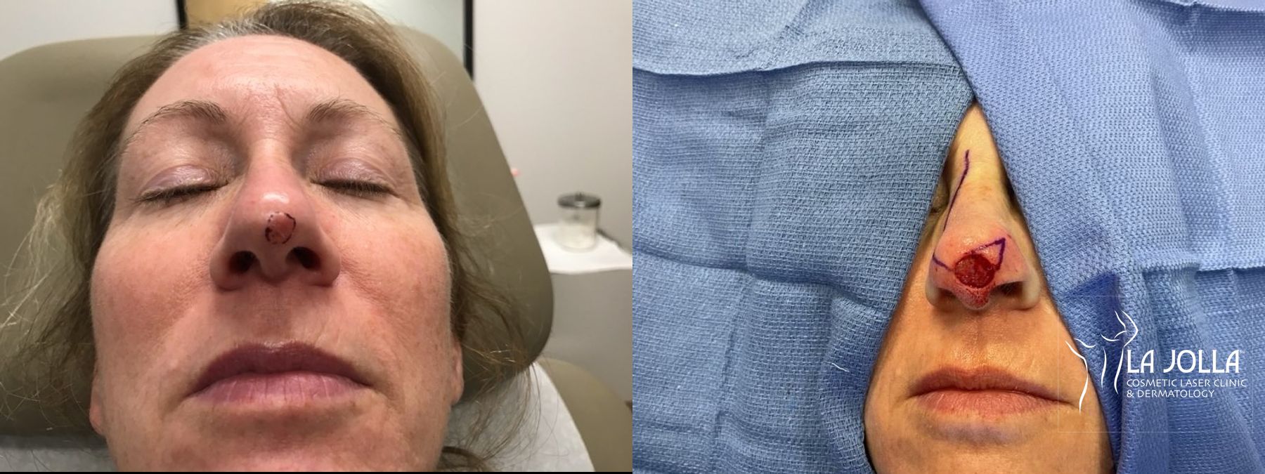 Before and after Mohs Surgery case 36078