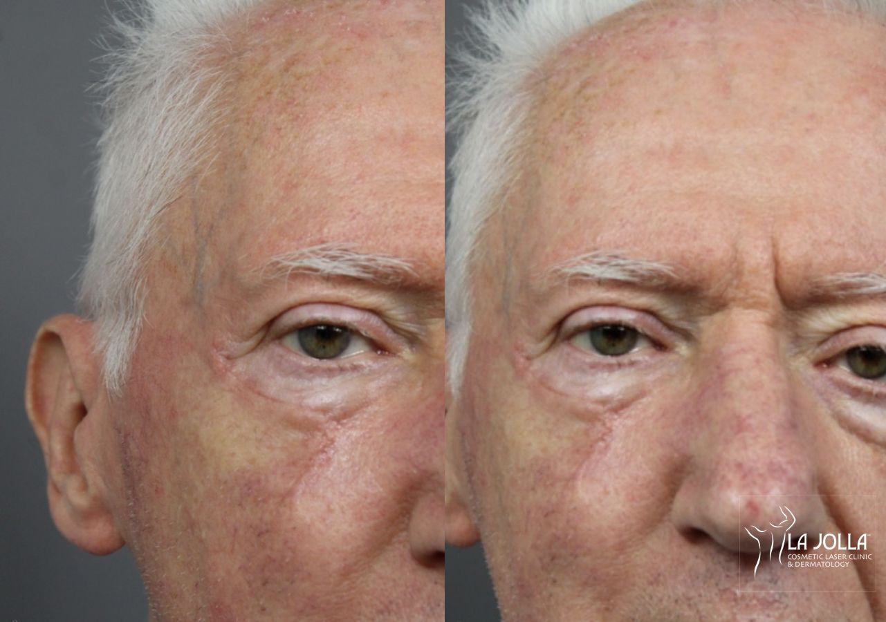 Before and after Mohs Surgery case 36093 - Angle 3