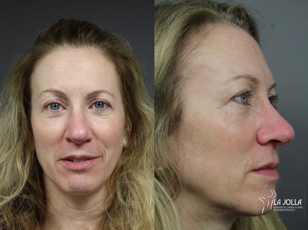 Before and after Mohs Surgery case 36078 - Angle 3