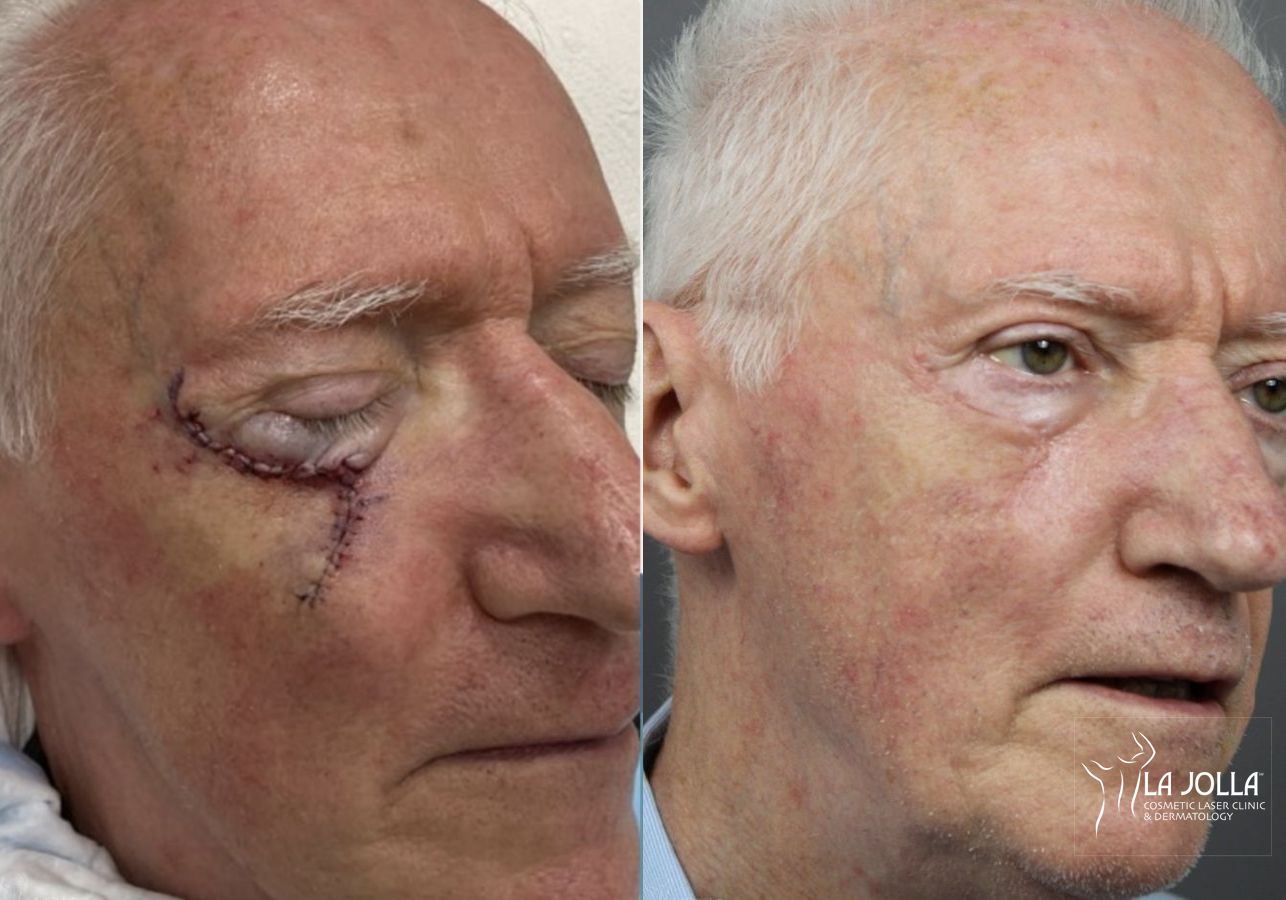 Before and after Mohs Surgery case 36093 - Angle 2
