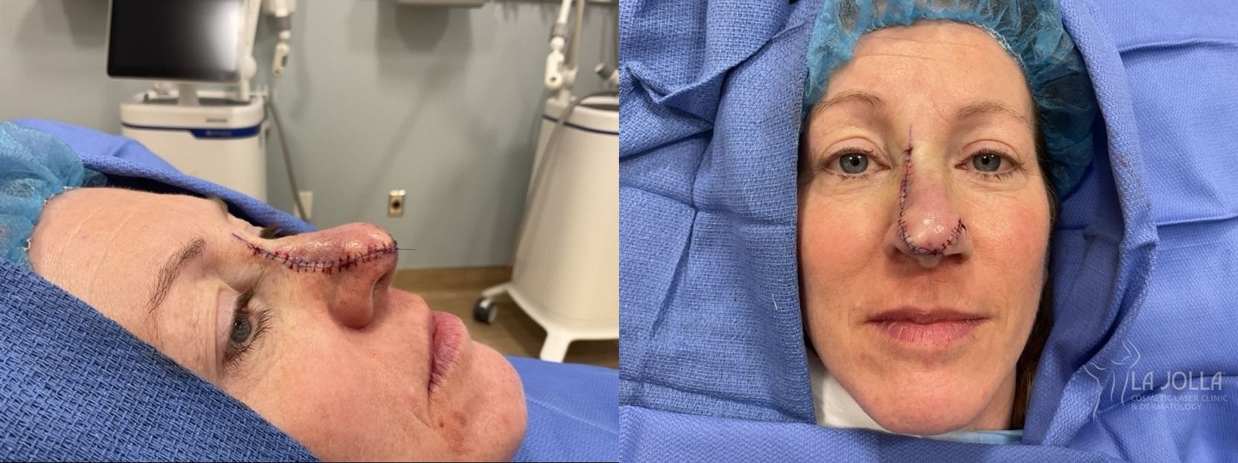 Before and after Mohs Surgery case 36078 - Angle 2