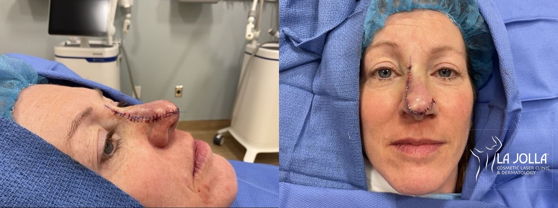 Before and after Mohs Surgery case 36078 - Angle 2