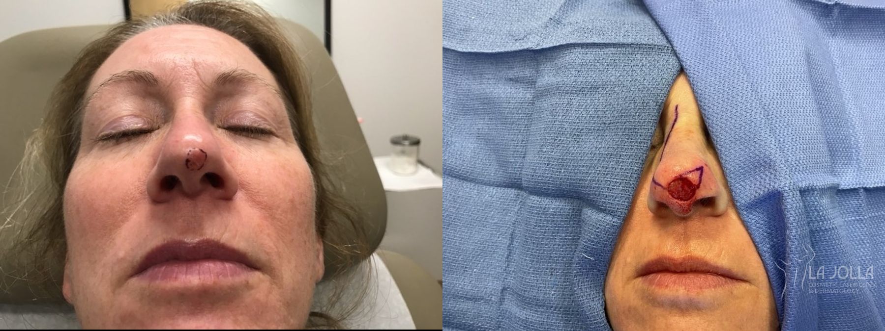 Before and after Mohs Surgery case 36078