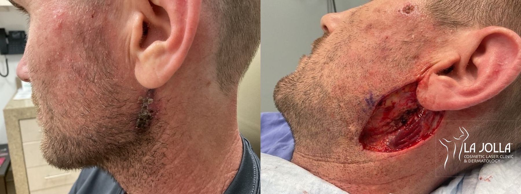 Before and after Mohs Surgery case 36430