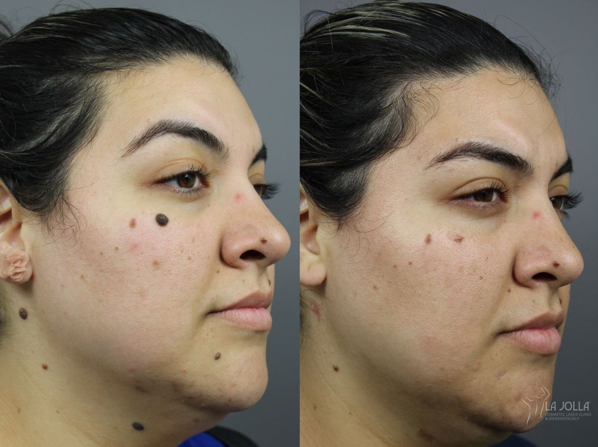 Before and after Mole Removal case 36389