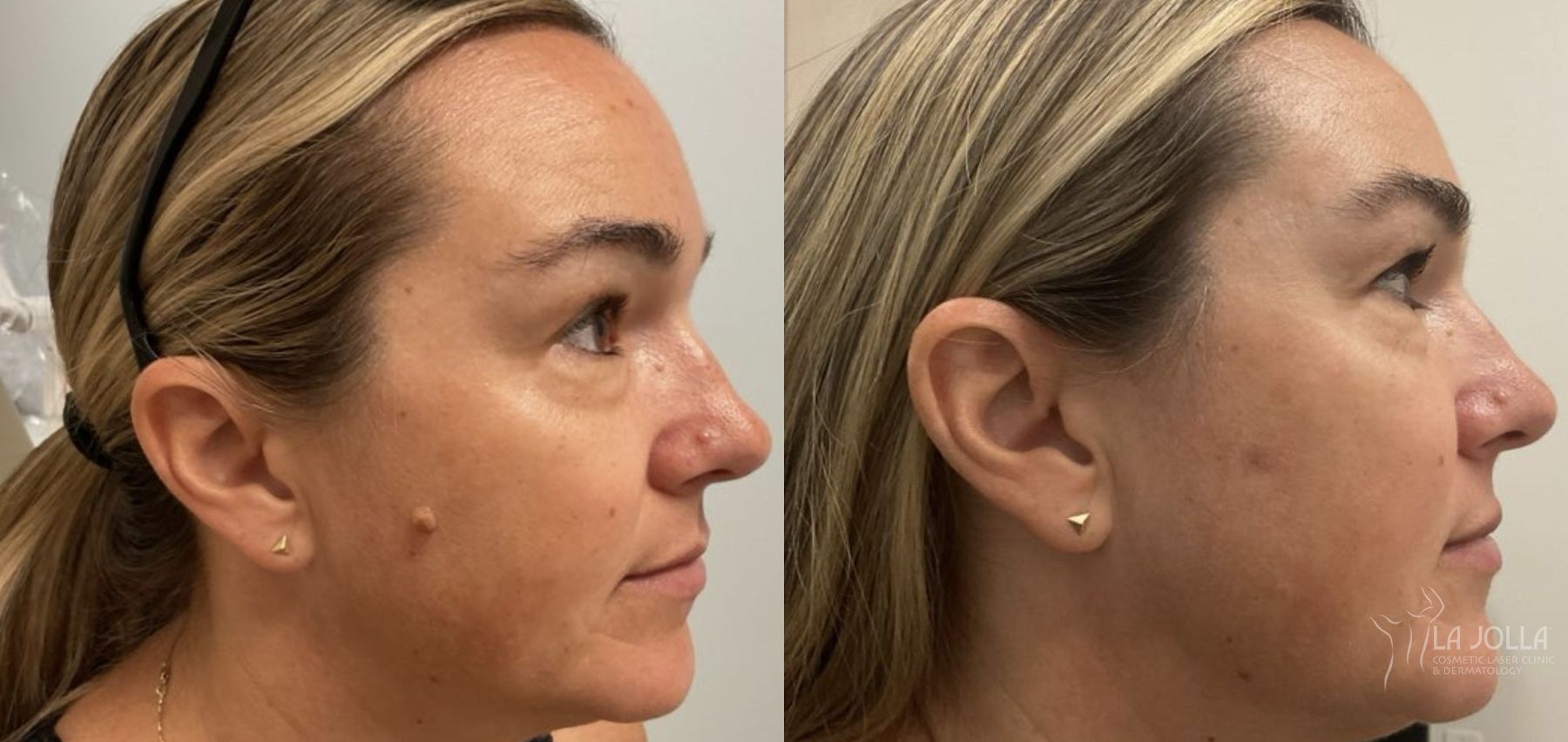 Before and after Mole Removal case 36366