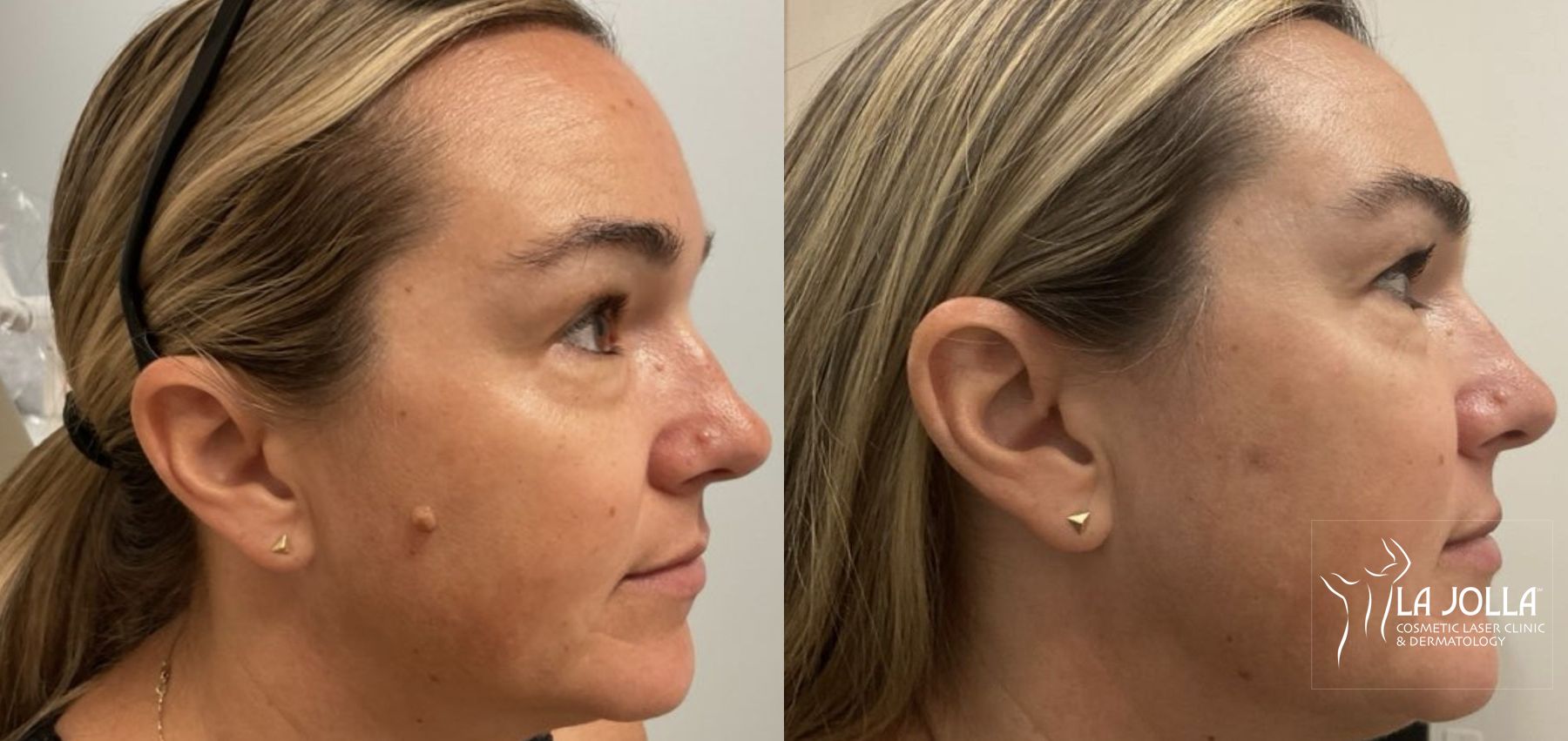 Before and after Mole Removal case 36366