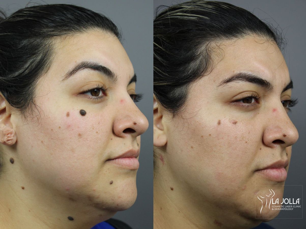 Before and after Mole Removal case 36389