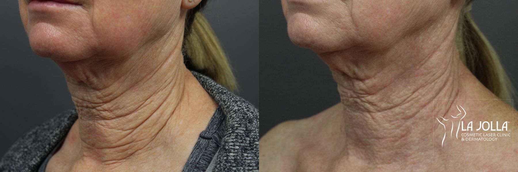 Before and after Laser Coring (Poke A Dot Lift®) case 36396