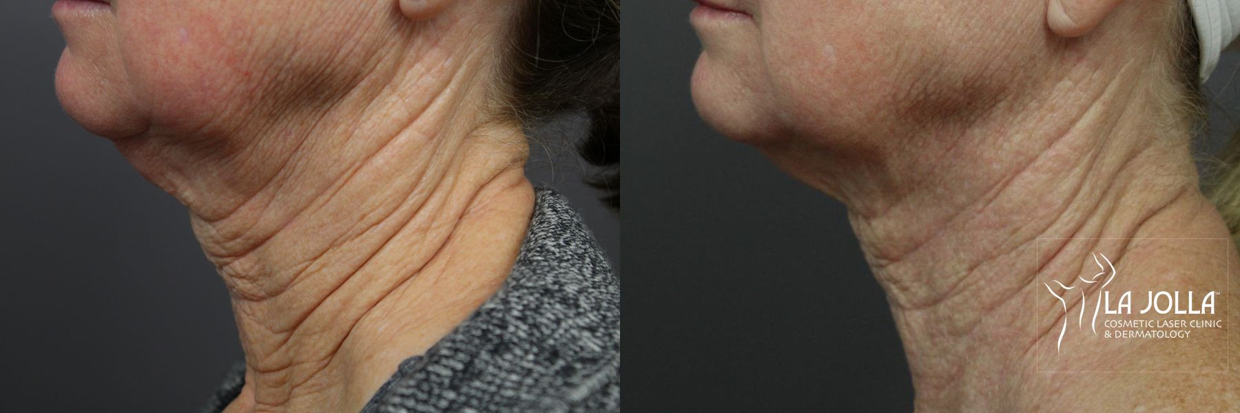 Before and after Laser Coring (Poke A Dot Lift®) case 36396 - Angle 2