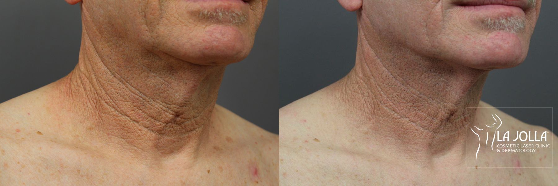 Before and after Laser Coring (Poke A Dot Lift®) case 36386