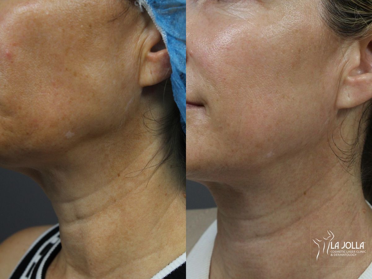 Before and after Laser Coring (Poke A Dot Lift®) case 36404 - Angle 2