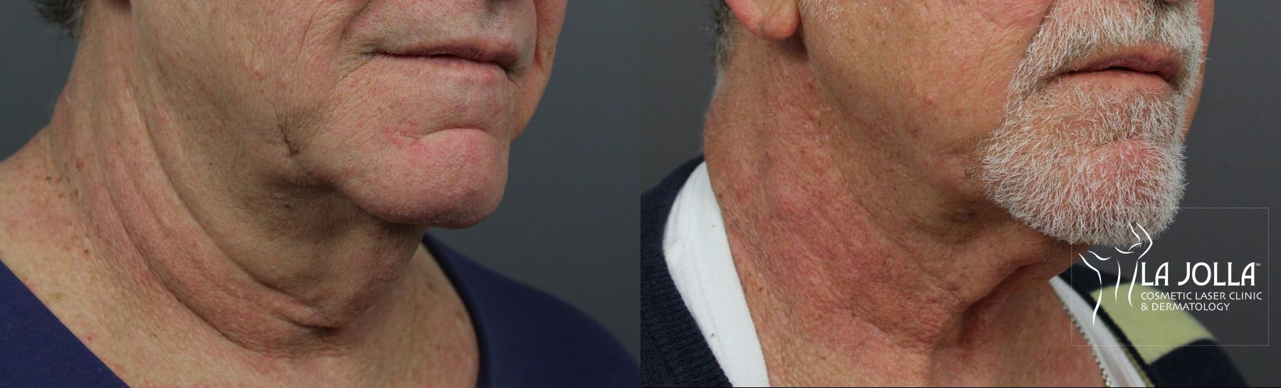 Before and after Laser Coring (Poke A Dot Lift®) case 36194