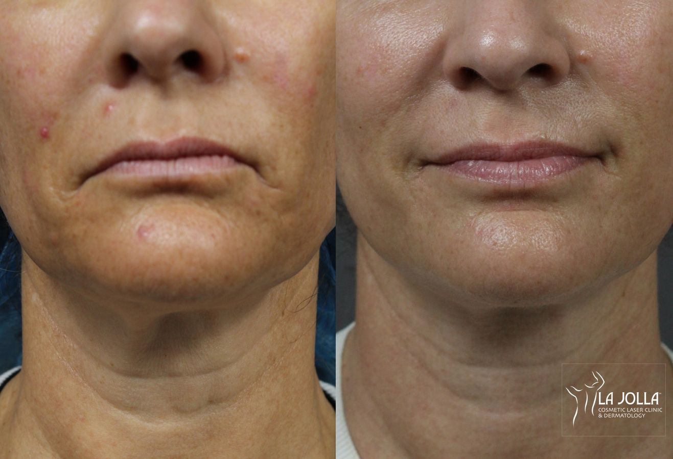 Before and after Laser Coring (Poke A Dot Lift®) case 36404