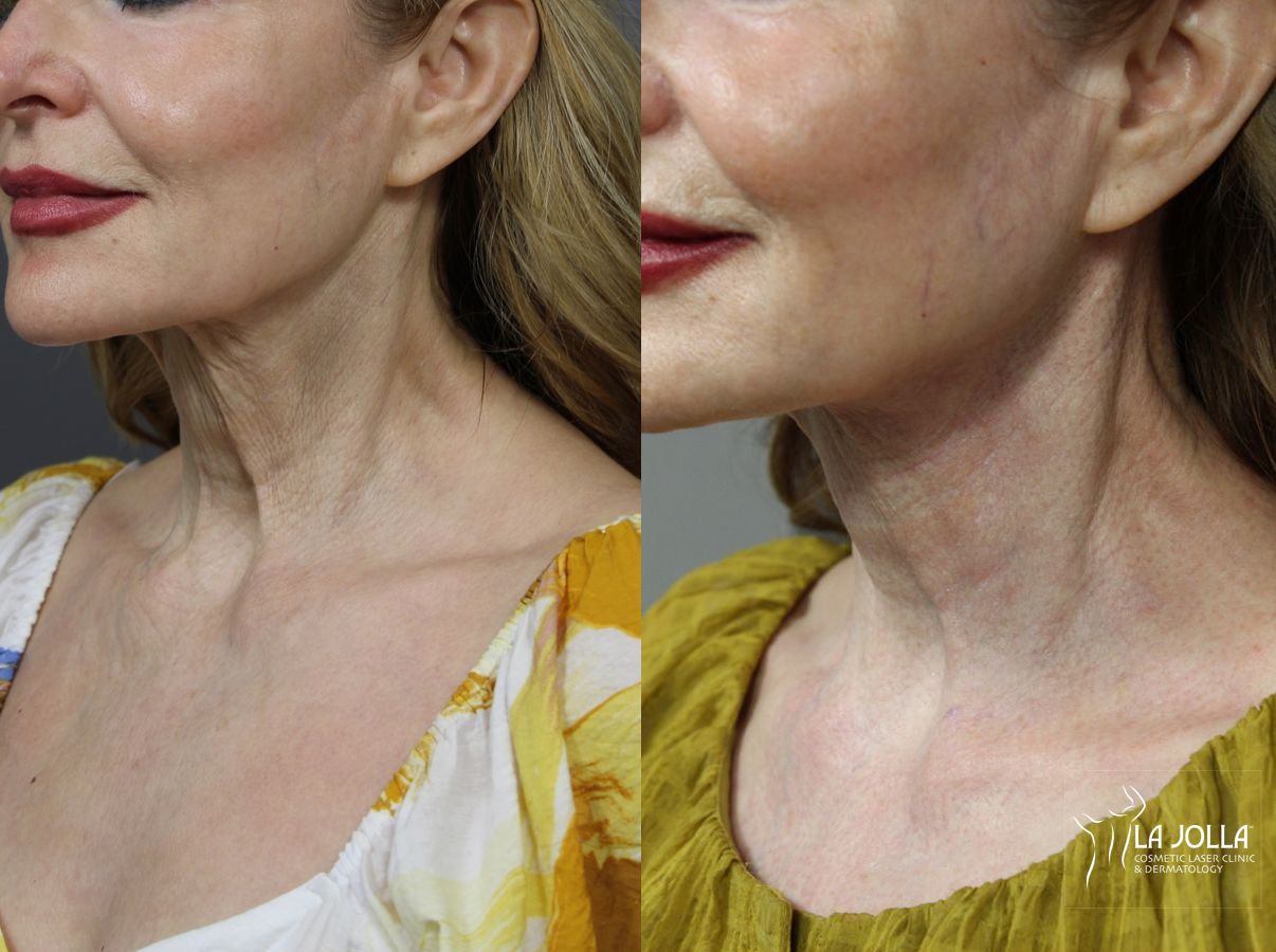 Before and after Laser Coring (Poke A Dot Lift®) case 36104 - Angle 3