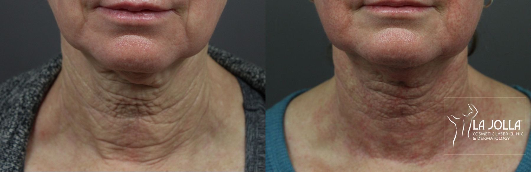 Before and after Laser Coring (Poke A Dot Lift®) case 36157 - Angle 2