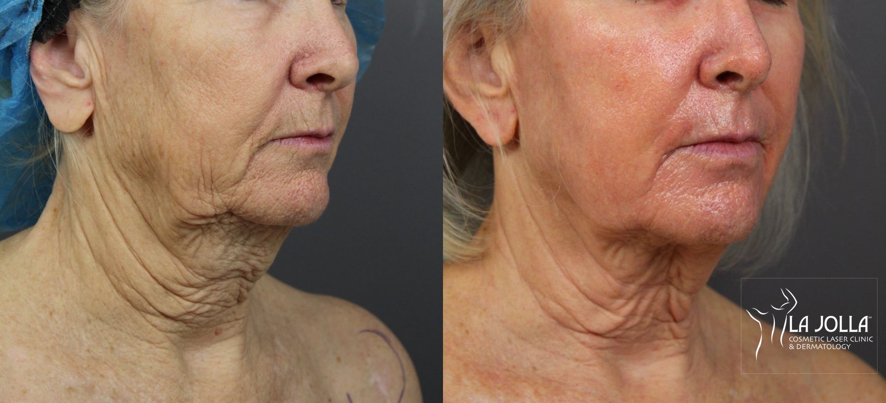 Before and after Laser Coring (Poke A Dot Lift®) case 36123 - Angle 3