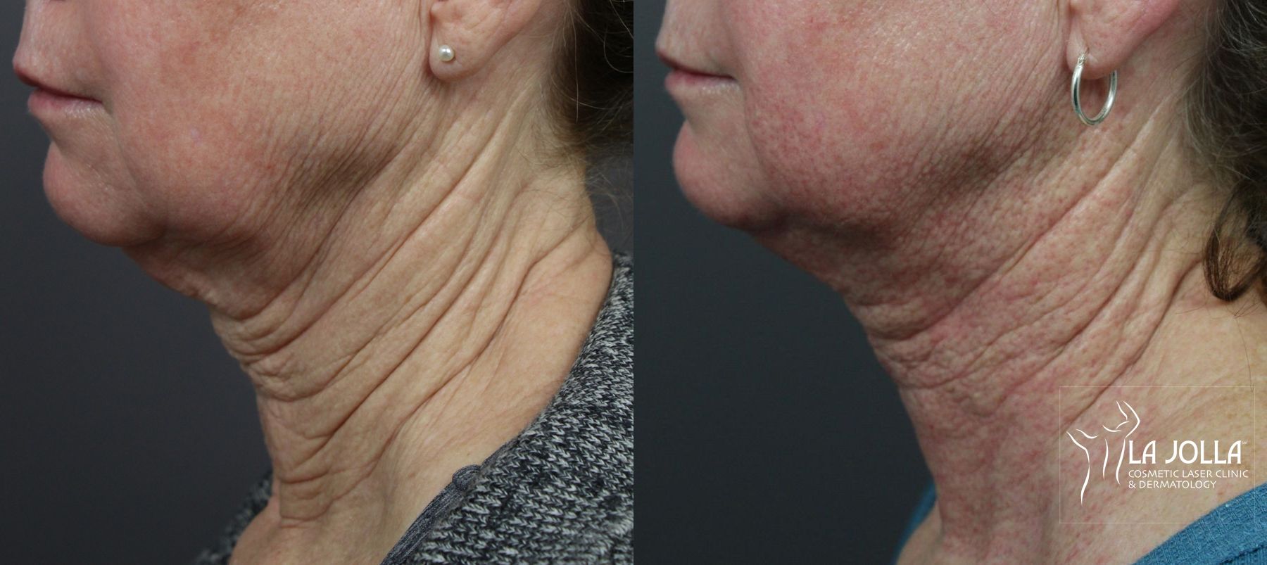 Before and after Laser Coring (Poke A Dot Lift®) case 36157