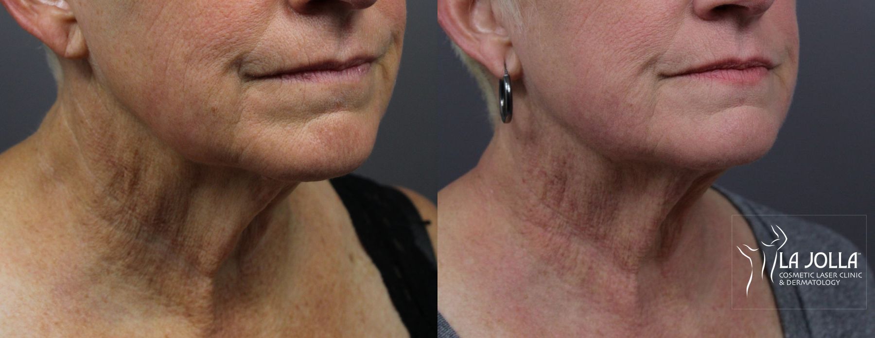 Before and after Laser Coring (Poke A Dot Lift®) case 36177