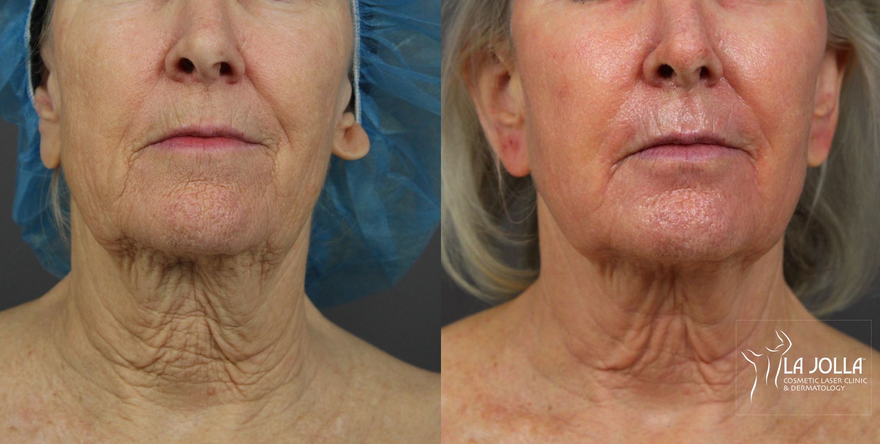 Before and after Laser Coring (Poke A Dot Lift®) case 36123