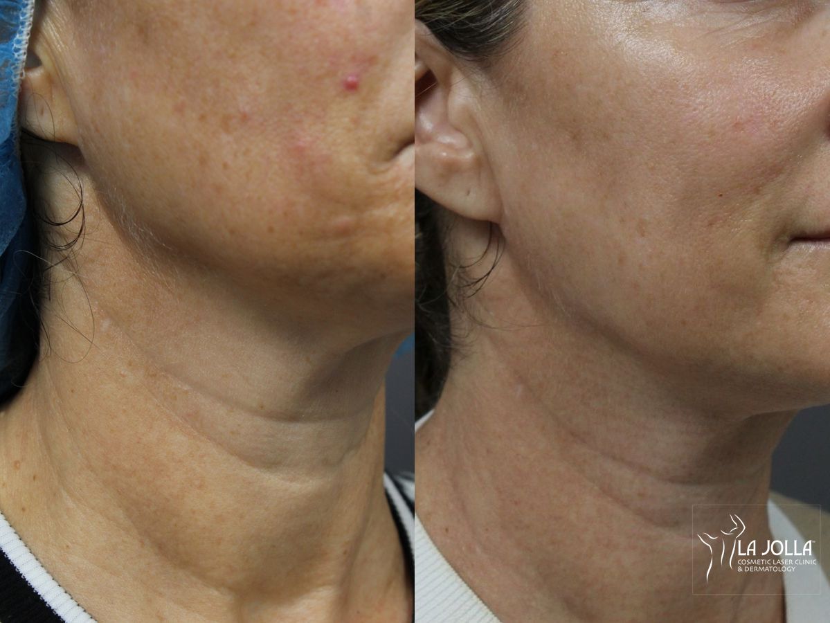 Before and after Laser Coring (Poke A Dot Lift®) case 36404 - Angle 3