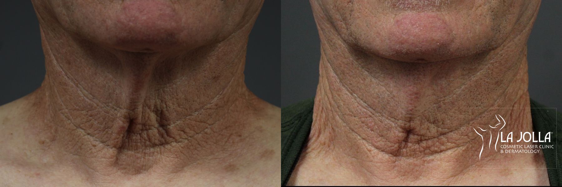 Before and after Laser Coring (Poke A Dot Lift®) case 36091