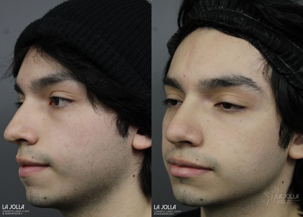 Before and after Nose Filler case 36109 - Angle 2