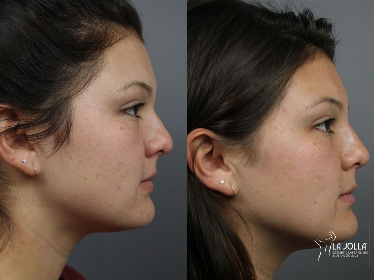 Before and after Nose Filler case 36234