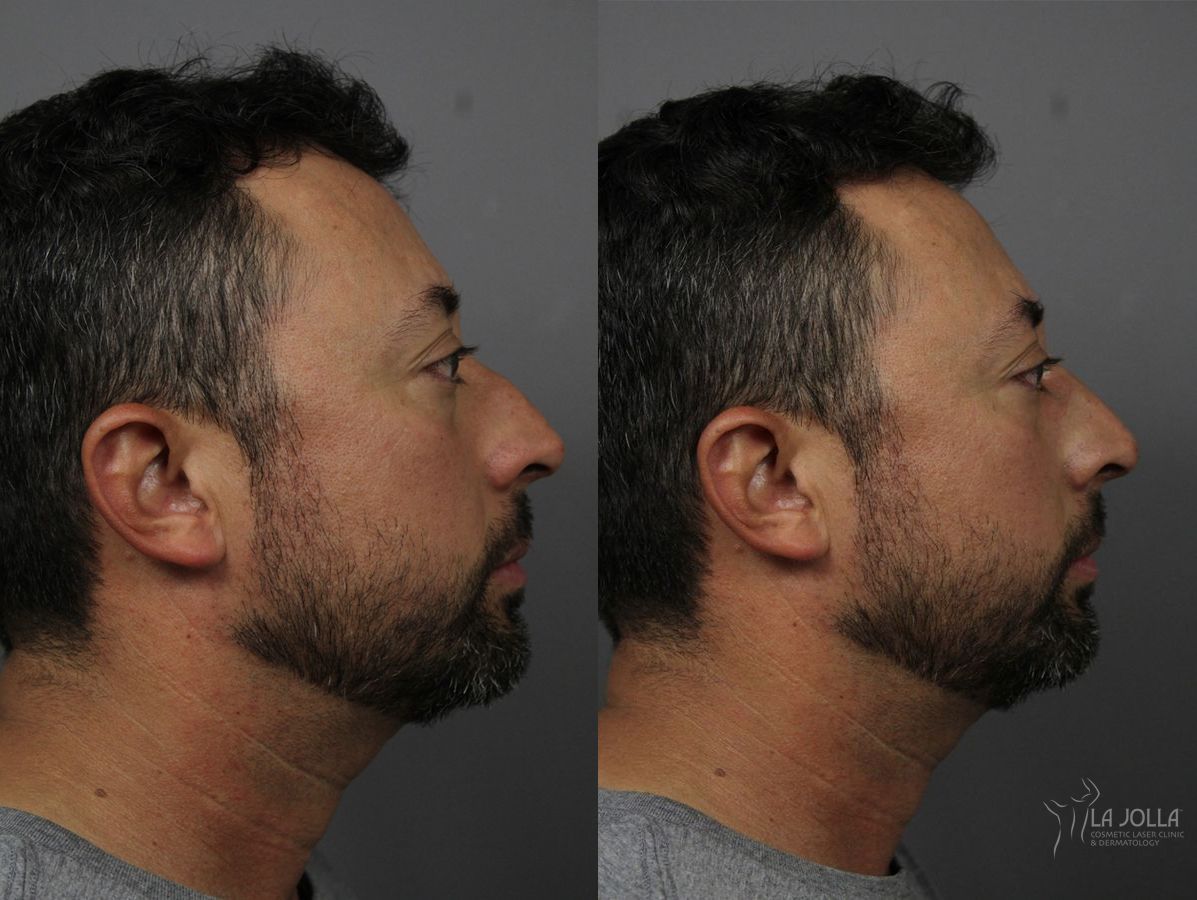 Before and after Nose Filler case 36136 - Angle 2