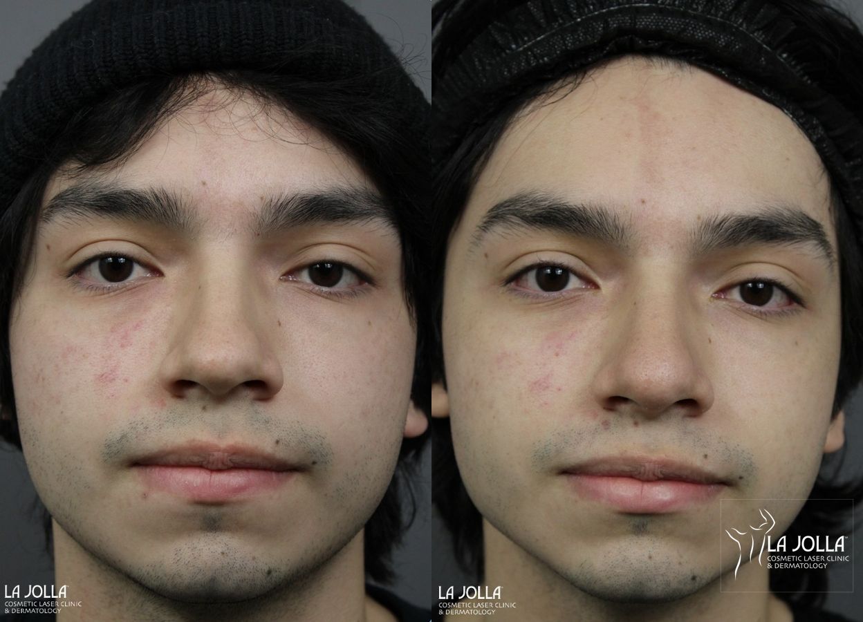 Before and after Nose Filler case 36109