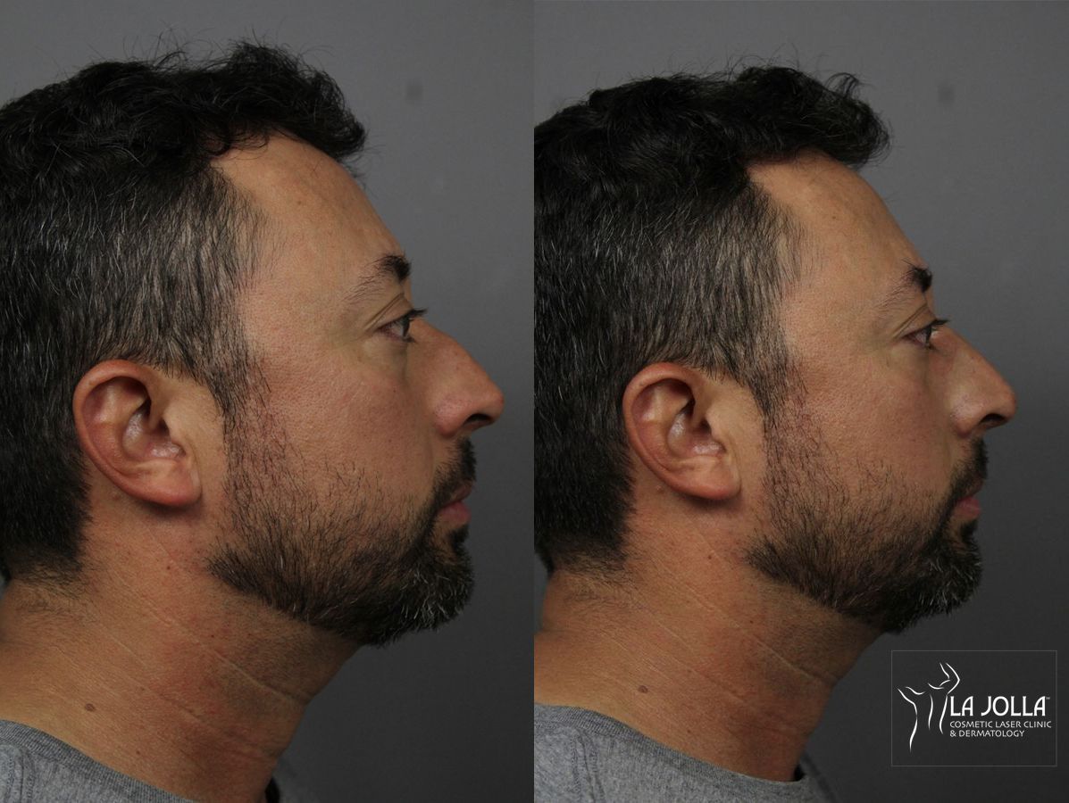 Before and after Nose Filler case 36136 - Angle 2