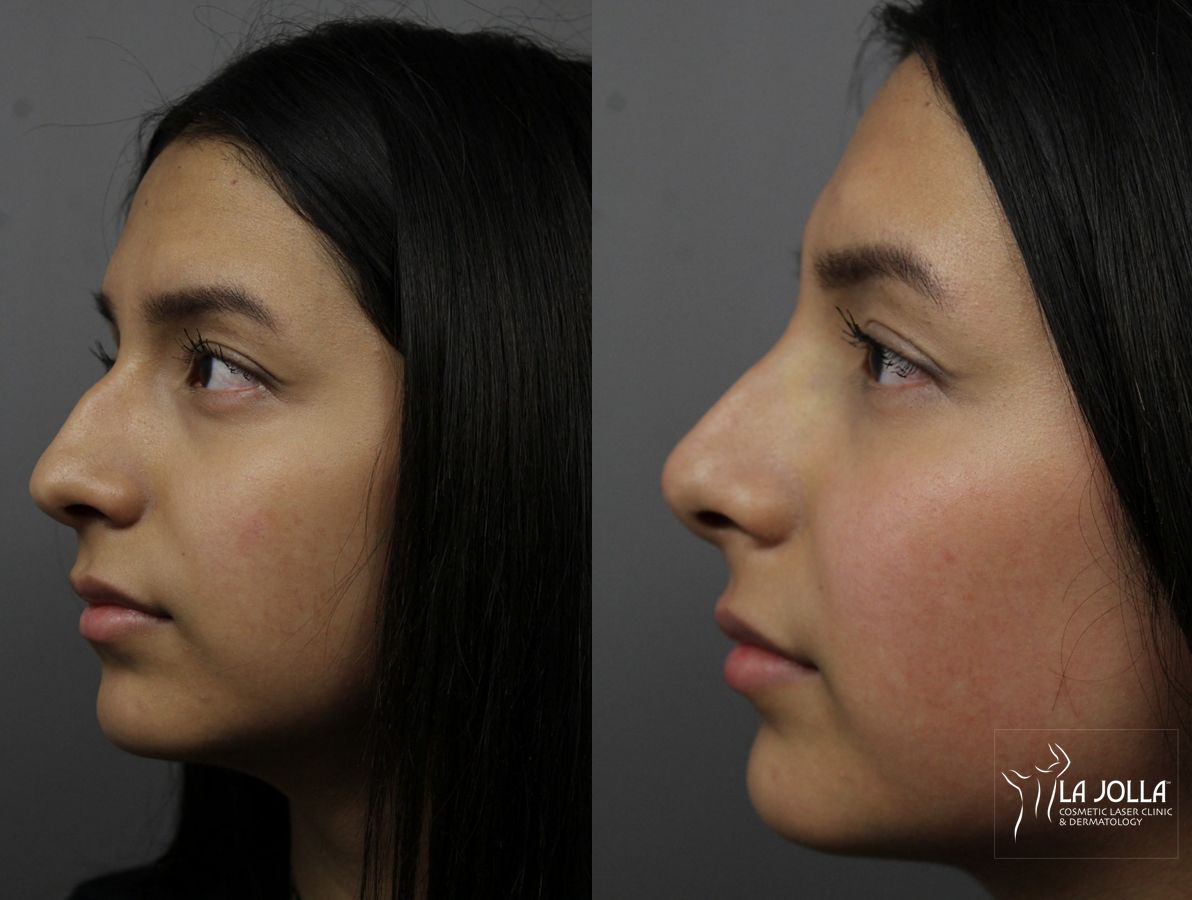 Before and after Nose Filler case 36167