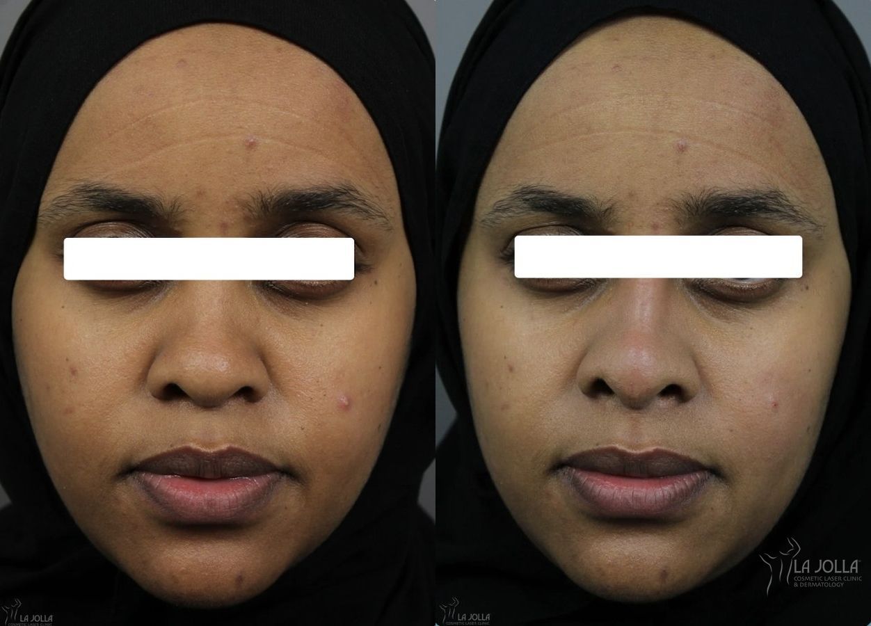 Before and after Nose Filler case 36066