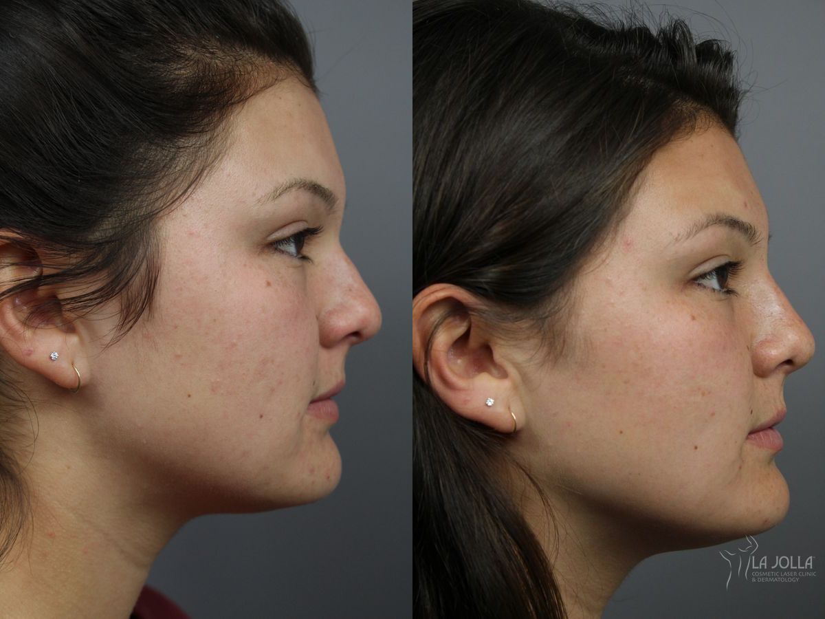 Before and after Nose Filler case 36234