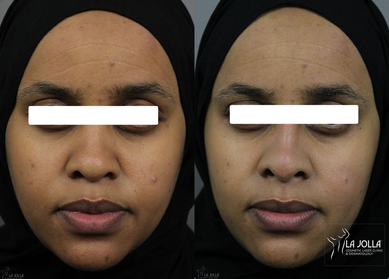 Before and after Nose Filler case 36066