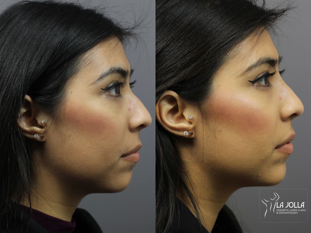 Before and after Nose Filler case 36213