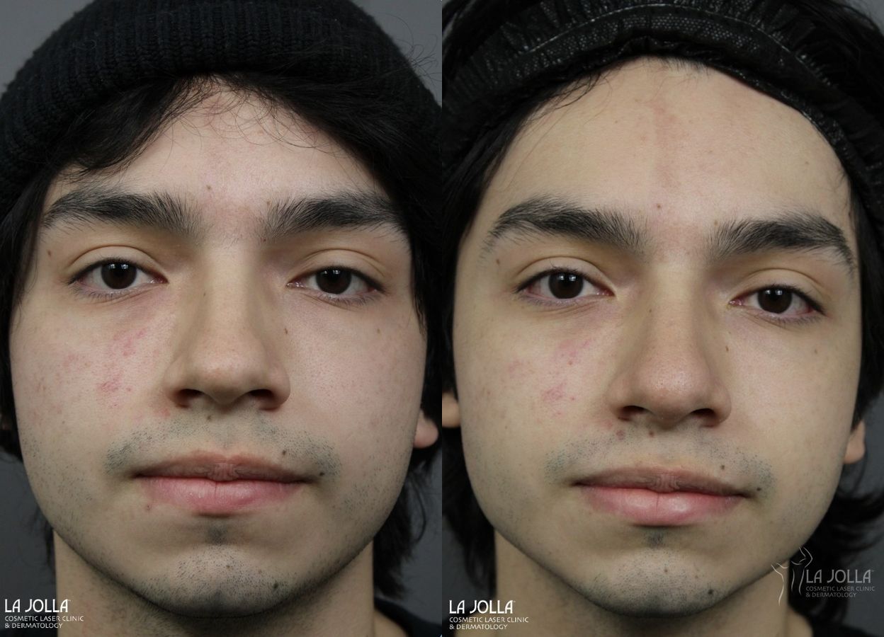Before and after Nose Filler case 36109