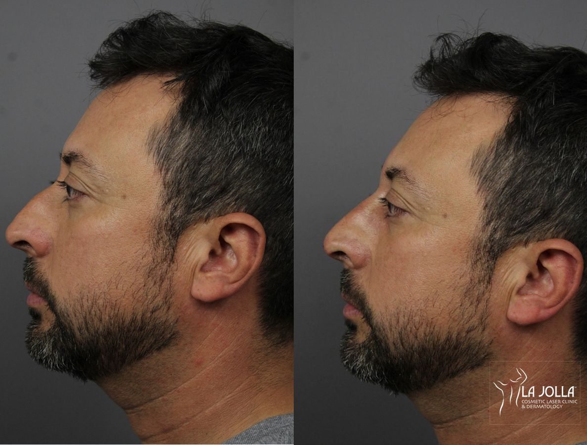 Before and after Nose Filler case 36136