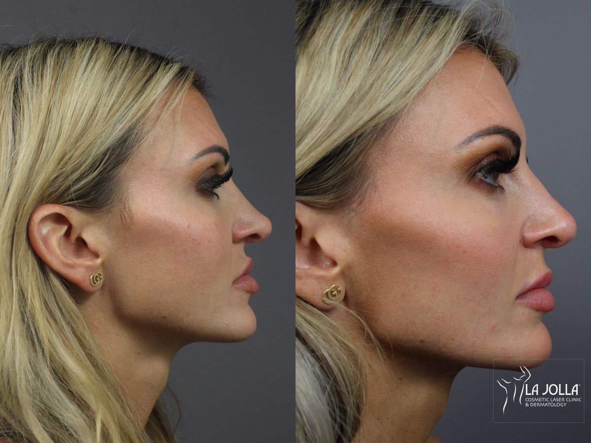 Before and after Nose Filler case 36187