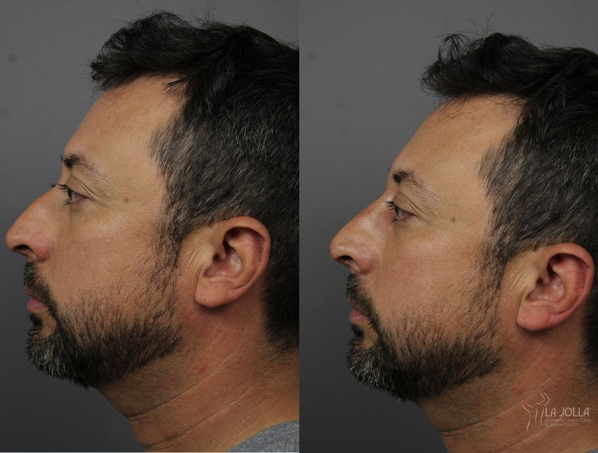 Before and after Nose Filler case 36136