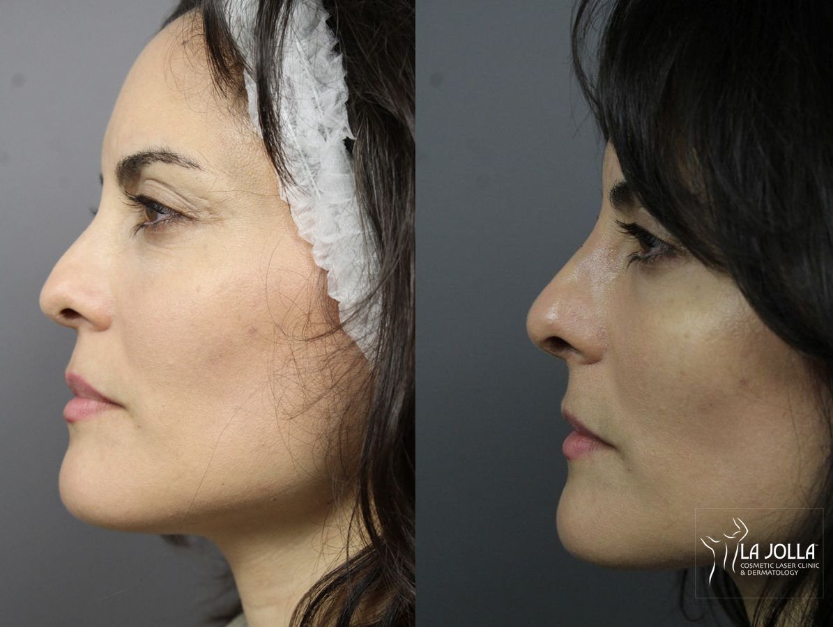 Before and after Nose Filler case 36146