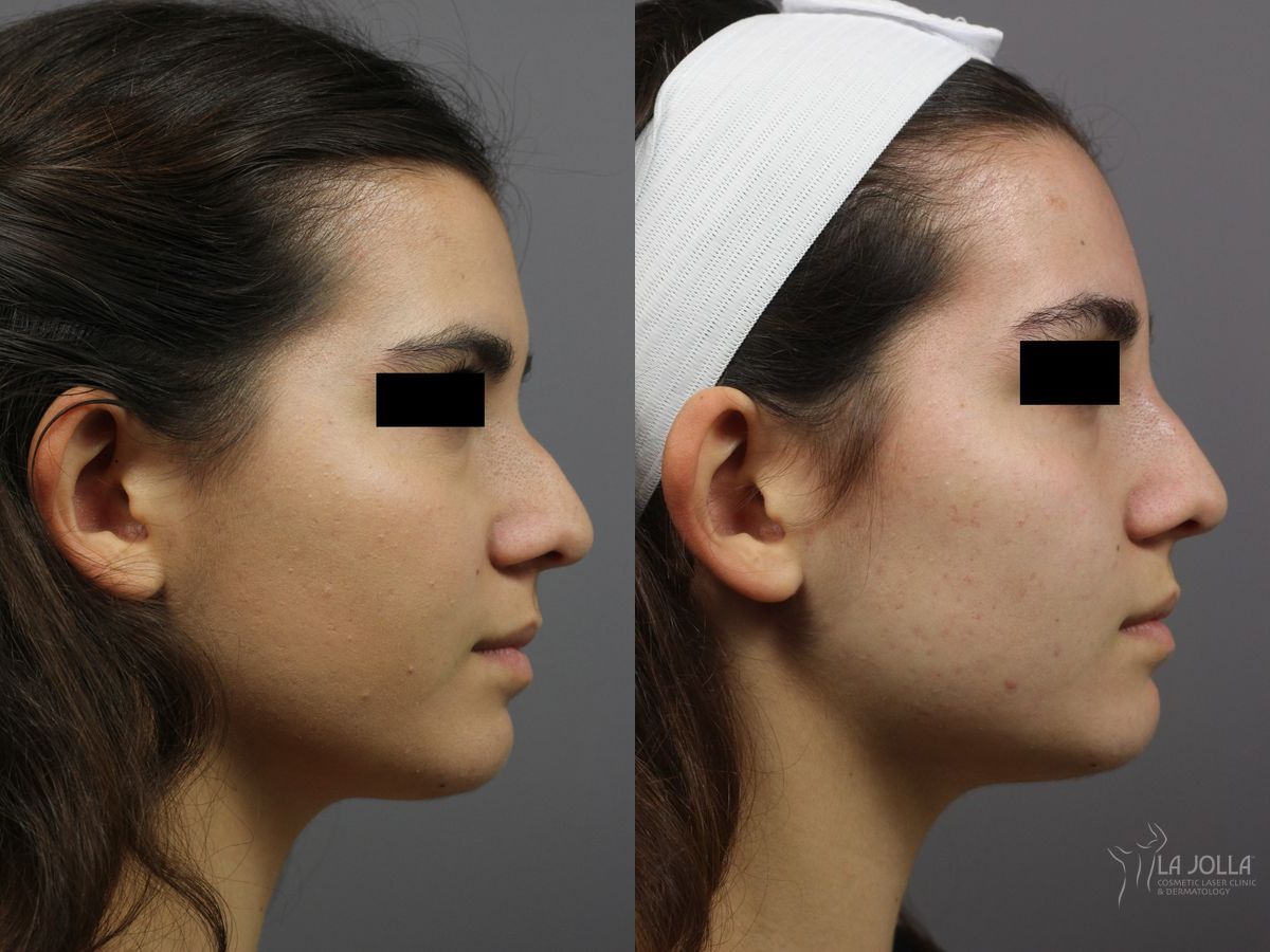 Before and after Nose Filler case 36238
