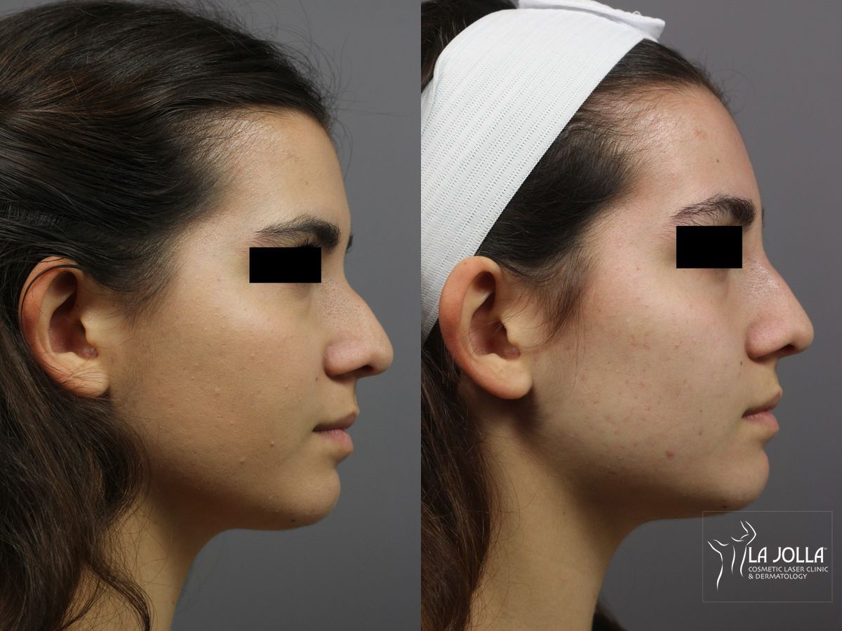Before and after Nose Filler case 36238