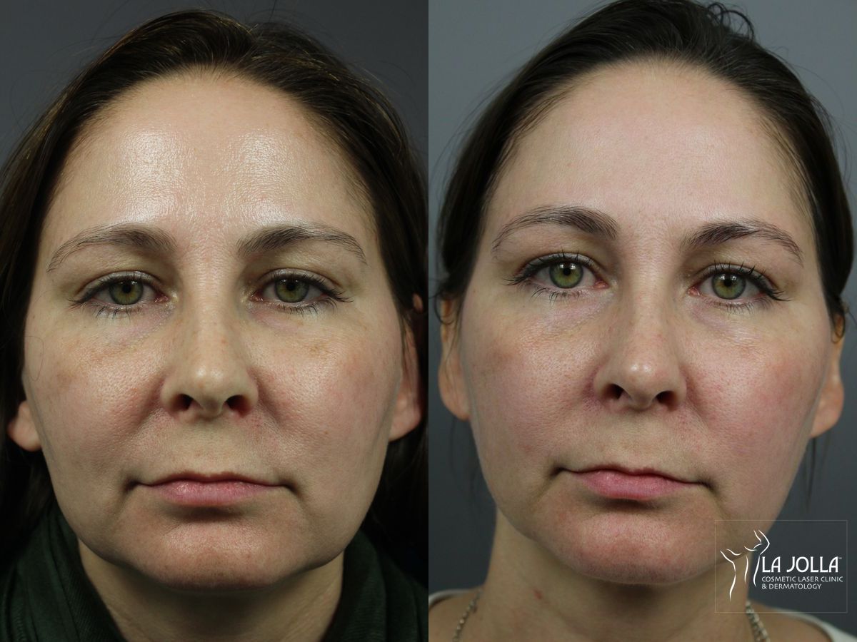 Before and after PRP Liquid Facelift case 36407