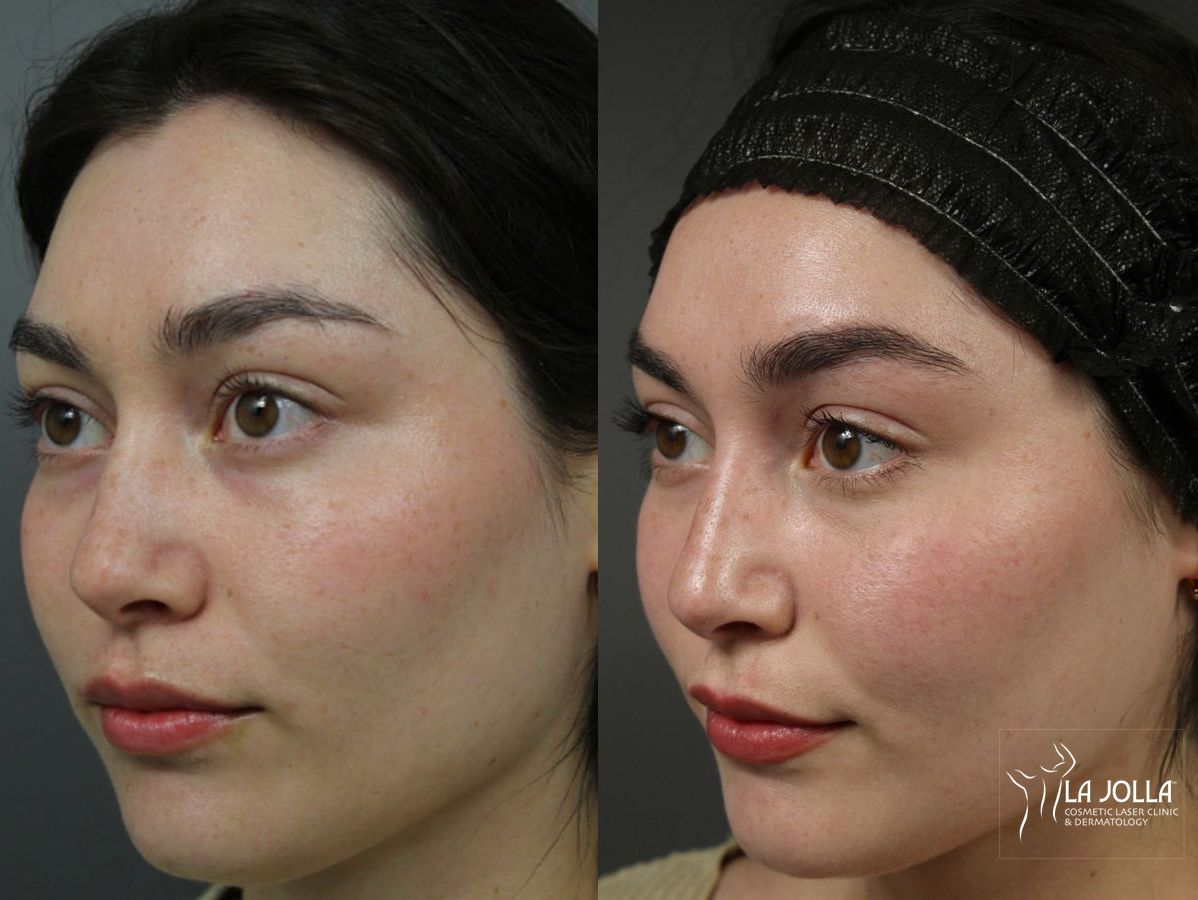 Before and after PRP Liquid Facelift case 36443 - Angle 3